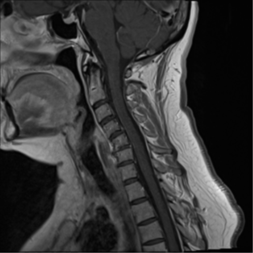 Multiple sclerosis | Image | Radiopaedia.org