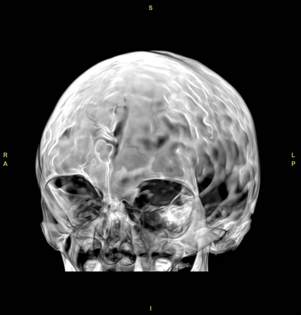 Copper Beaten Skull Radiology Reference Article