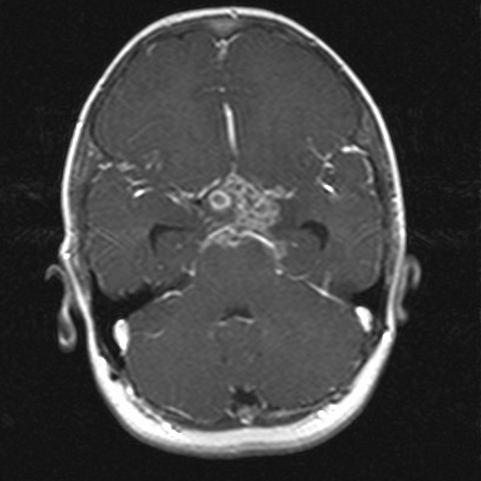 Viewing playlist: Lepto vs. Pachy-Meninges | Radiopaedia.org