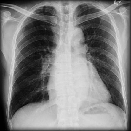 Left atrial enlargement and mitral valve calcification | Radiology Case ...