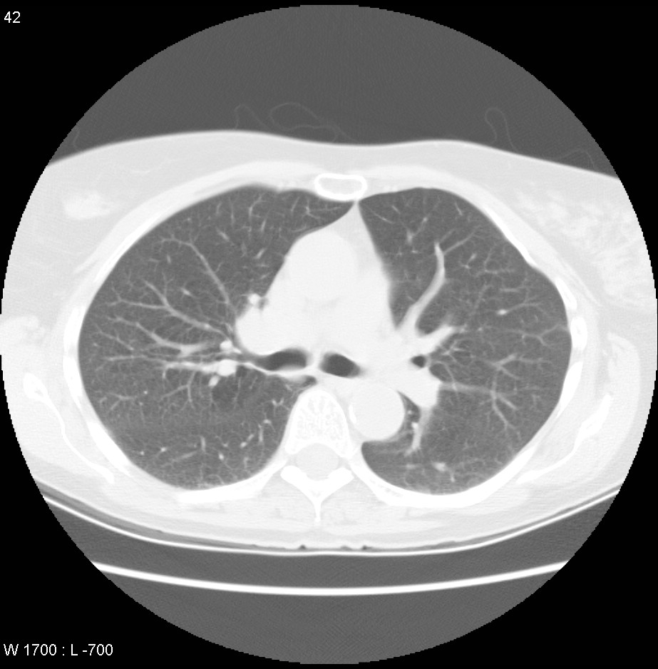 Post radiotherapy pulmonary fibrosis | Image | Radiopaedia.org