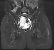 Ovarian torsion | Radiology Reference Article | Radiopaedia.org