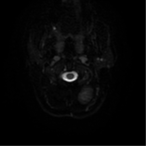 Tuberous Sclerosis Multisystem Manifestations Image