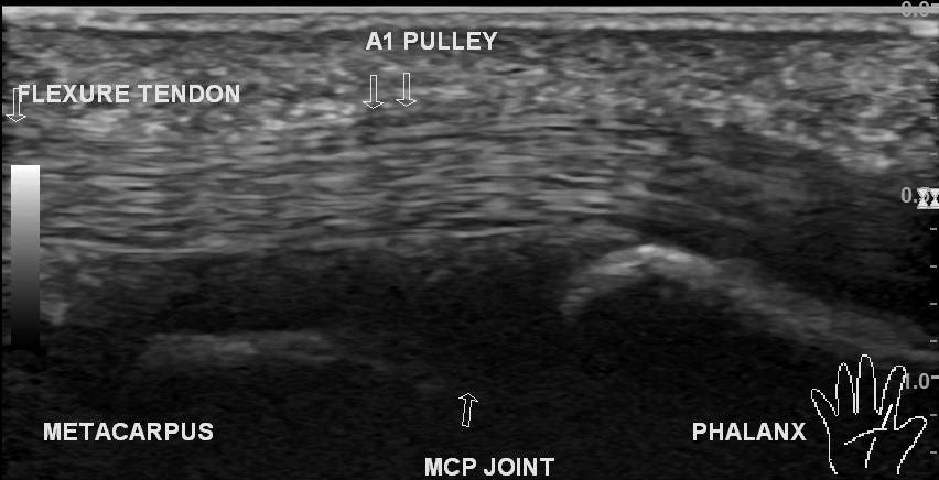 Peri A2 pulley ganglion | Image | Radiopaedia.org