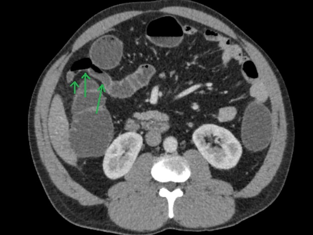 Meckel diverticulum | Image | Radiopaedia.org