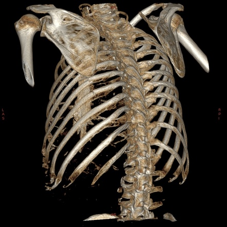 Blunt Chest Trauma | Radiology Case | Radiopaedia.org