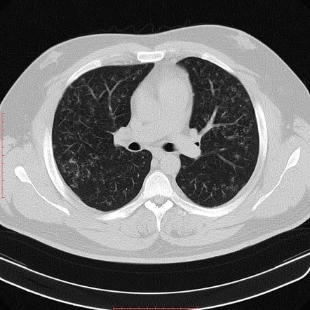 Pulmonary Langerhans cell histiocytosis | Radiology Case | Radiopaedia.org