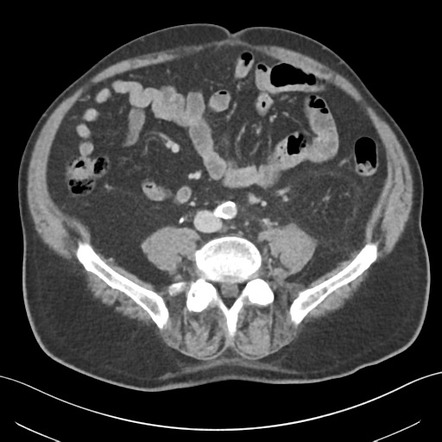 Subcapsular perirenal hematoma | Image | Radiopaedia.org