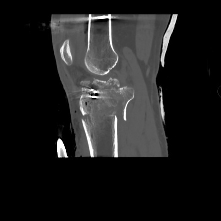 Tibial Plateau Fracture: Schatzker Type VI | Image | Radiopaedia.org