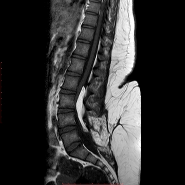 Spinal dysraphism with cord lipoma Radiology Case Radiopaedia