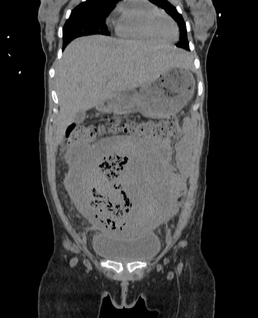 Pregnant Bicornuate Unicollis Uterus With Cornual Purperal Sepsis