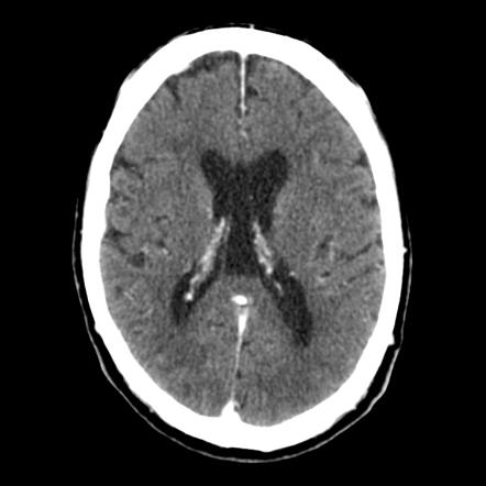 Cavum Vergae Radiology Reference Article Radiopaedia Org