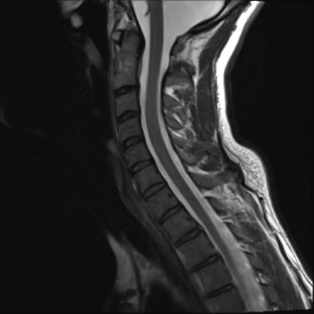 Cerebellar agenesis with hypoplastic pons (pontocerebellar hypoplasia ...