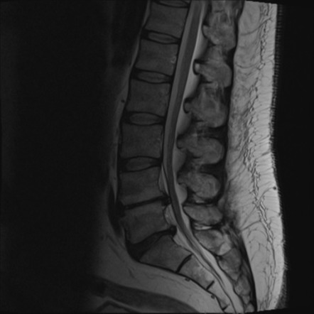 Epidural lipomatosis of the lumbar spine | Image | Radiopaedia.org