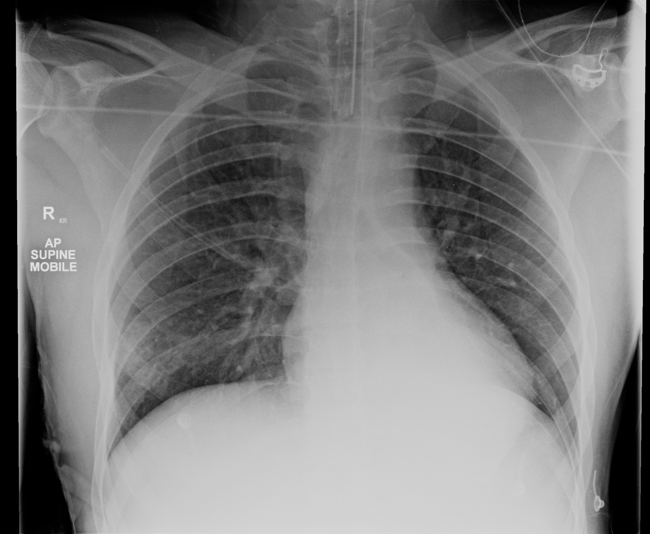 Left lower lobe collapse | Image | Radiopaedia.org