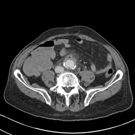 Aortoenteric Fistula (secondary) 