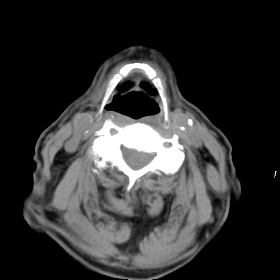 Warthin tumor of parotid gland | Image | Radiopaedia.org