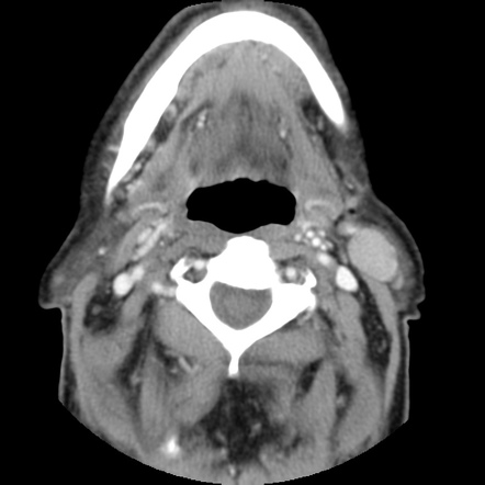 Viewing playlist: 6a_053 Imaging Neck Masses in Adults | Radiopaedia.org