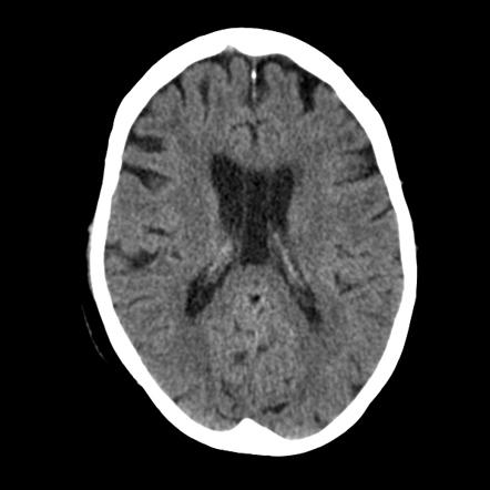 Cavum vergae | Radiology Reference Article | Radiopaedia.org