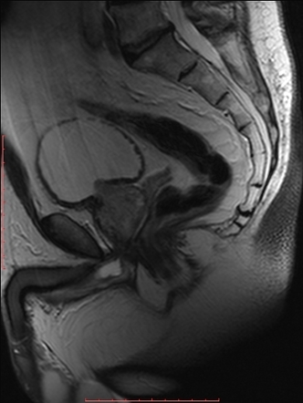 Cowper duct syringocele | Image | Radiopaedia.org