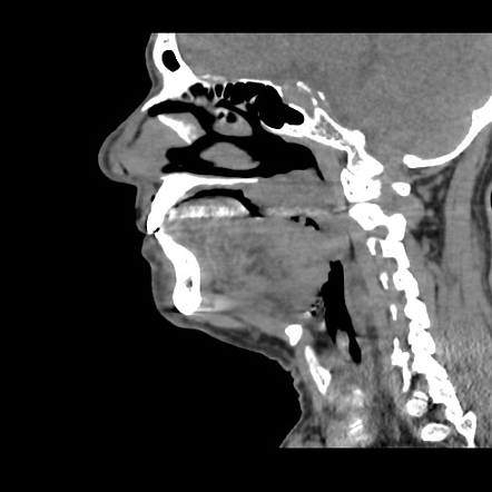 Squamous Cell Carcinoma (oral Cavity) | Image | Radiopaedia.org