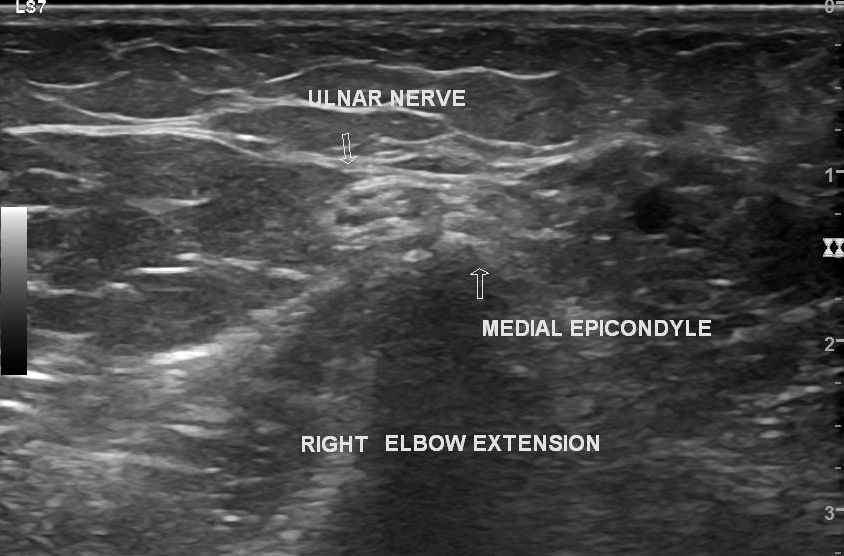 Triceps snapping syndrome лечение