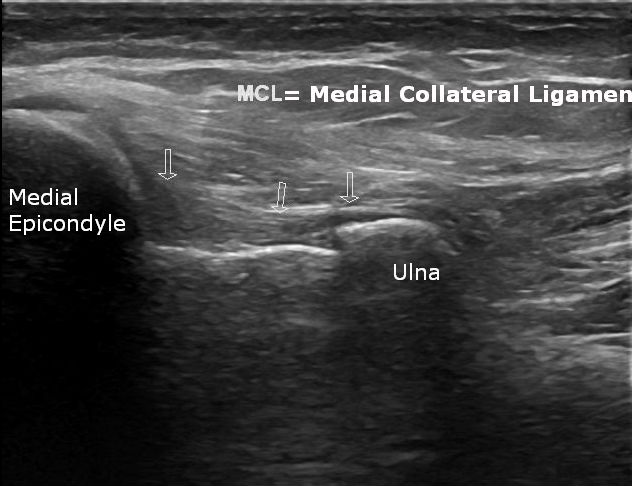 Triceps snapping syndrome лечение