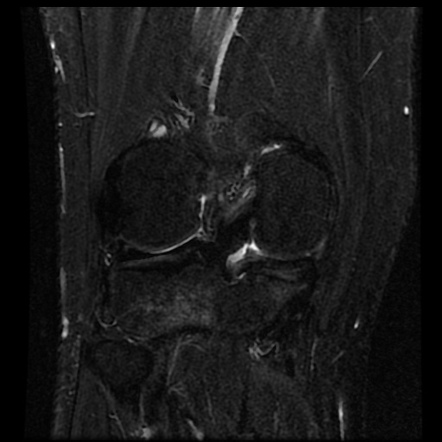 Meniscal Tear 