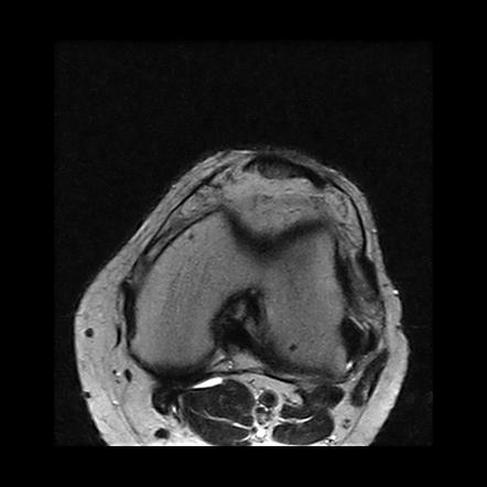 Iliotibial Band Syndrome 