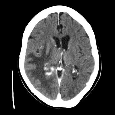 Playlist 'UQ Med Yr 1 Neuro: Brain trauma and CVA' by Assoc Prof Craig ...