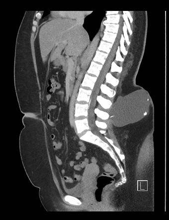 Dislodged lumboperitoneal shunt | Image | Radiopaedia.org