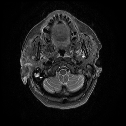 Malignant Otitis Externa Radiology