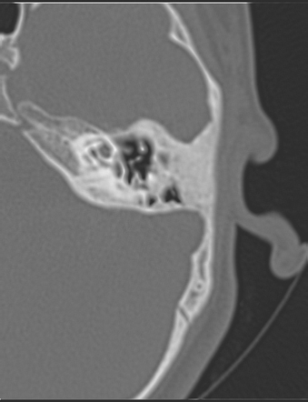 Bilateral Otosclerosis 