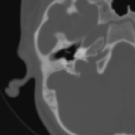 Otosclerosis Radiopaedia