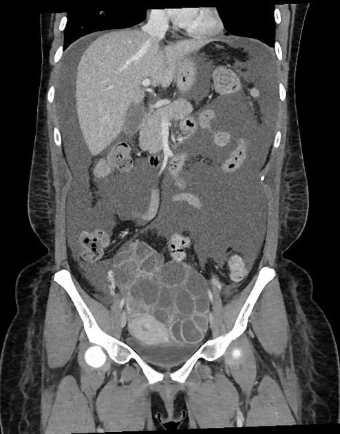 Ovarian hyperstimulation syndrome | Radiology Reference Article ...