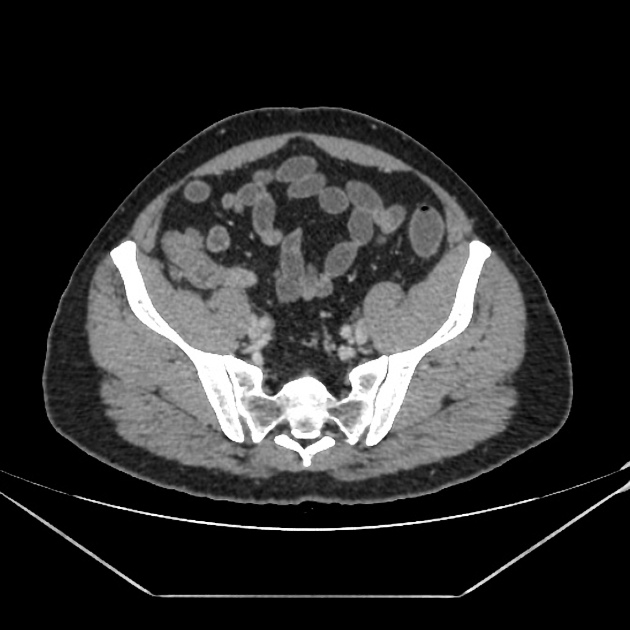 Featured image of post Acute Appendicitis Radiopaedia However in most people pain begins around the navel and then moves