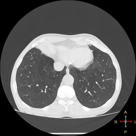 Inferior accessory fissure of the lung | Radiology Reference Article ...