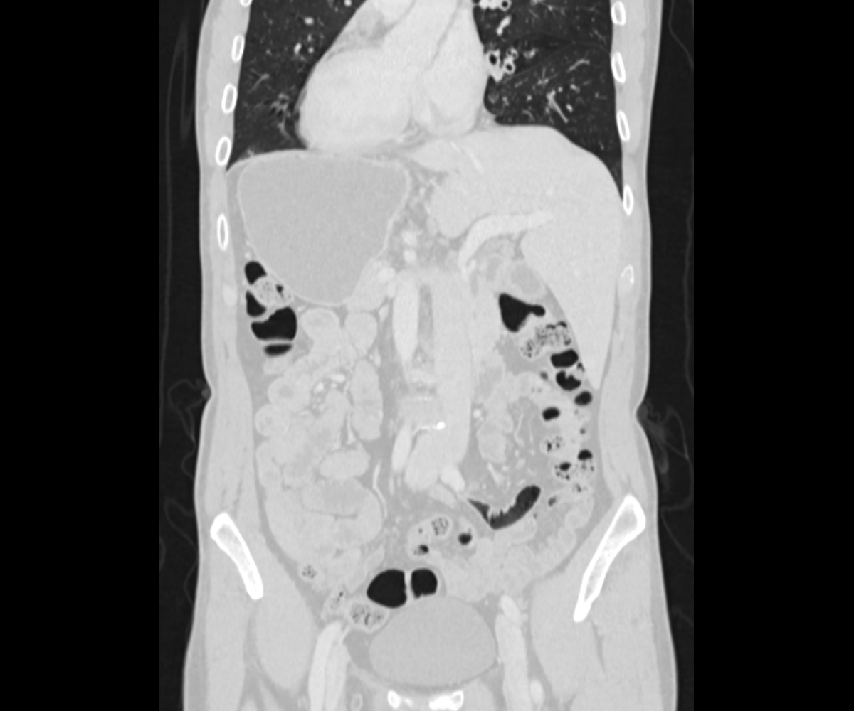 Situs Inversus Totalis Image