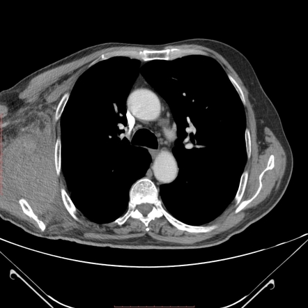 Subscapularis hematoma | Radiology Case | Radiopaedia.org