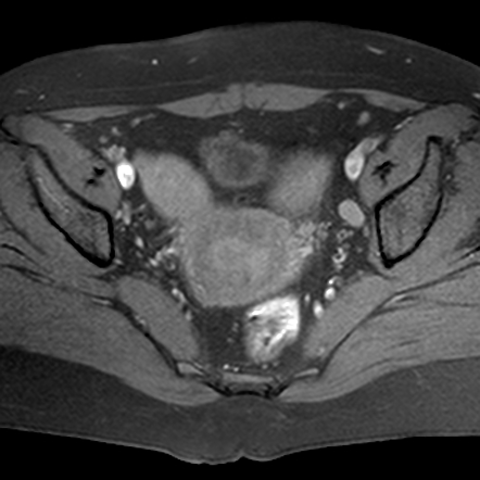 Herlyn-Werner-Wunderlich Syndrome | Image | Radiopaedia.org