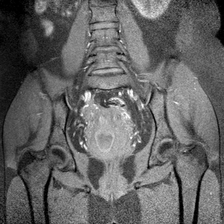 Herlyn-Werner-Wunderlich Syndrome | Image | Radiopaedia.org