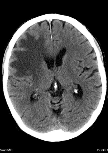 Radiology Quiz 23200 | Radiopaedia.org | Playlist 'CT Brain 