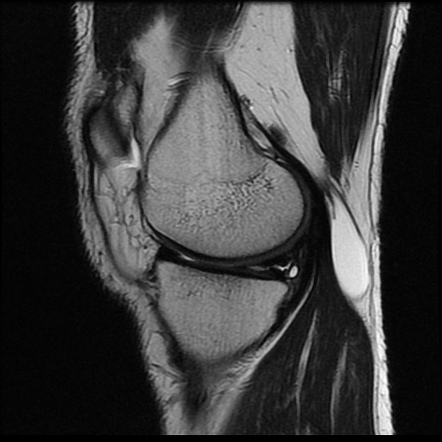 Meniscal cyst | Radiology Case | Radiopaedia.org