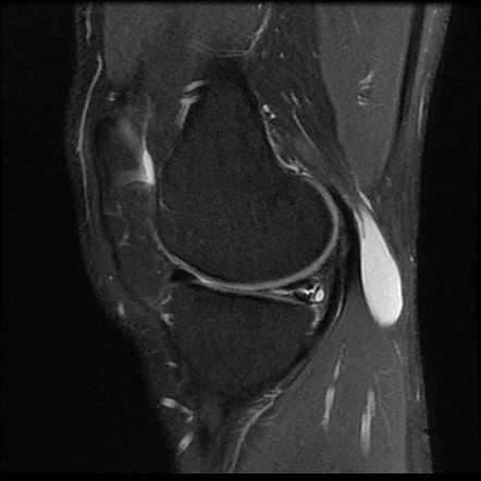 Meniscal Cyst Radiology Reference Article Radiopaedia Org