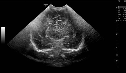 Lenticulostriate vasculopathy | Image | Radiopaedia.org