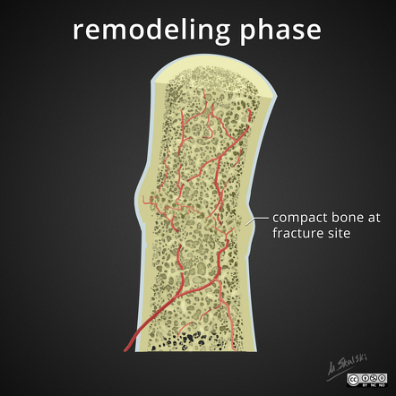 Fracture healing diagrams | Image | Radiopaedia.org