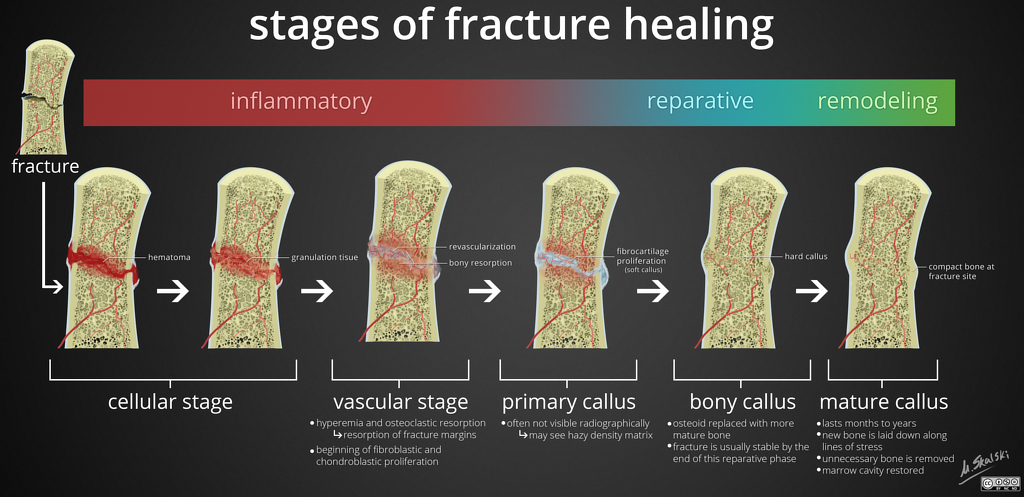 4 Stages Of Healing A Bone Fracture