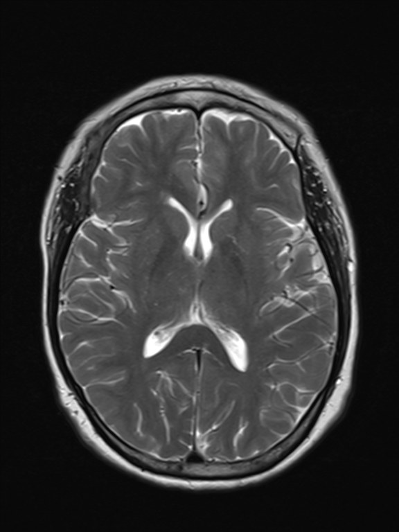 Cranio-facial fibrous dysplasia | Image | Radiopaedia.org