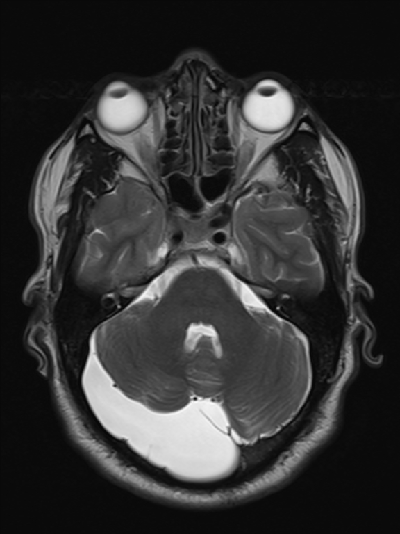 Retrocerebellar Arachnoid Cyst Mri