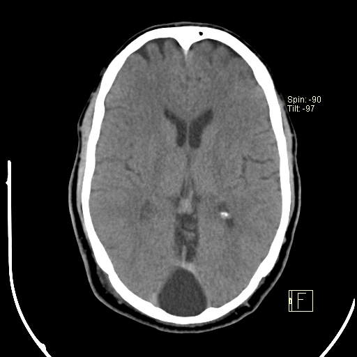 Retro-cerebellar arachnoid cyst | Image | Radiopaedia.org